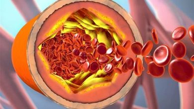 صورة طبيب يكشف 3 علامات تشير  إلي  انخفاض الكولسترول في الدم