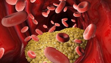 صورة 5 أعراض تكشف ارتفاع الكوليسترول في الدم