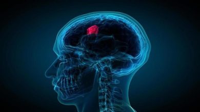صورة الأورام الدماغية.. الأعراض والأنواع والعلاج