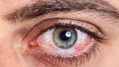 صورة احمرار العين والحكة المستمرة.. أعراض الإصابة حساسية العين وأسبابها
