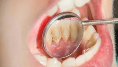 صورة طرق بسيطة وفعالة إزالة جير الأسنان