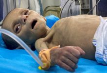 صورة 30 قتيلاً في غزة ضحية سوء التغذية والجفاف