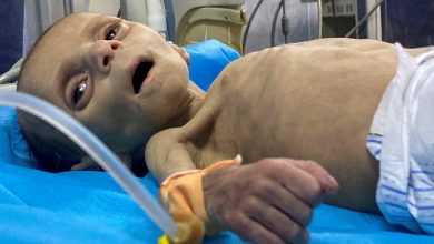 صورة 30 قتيلاً في غزة ضحية سوء التغذية والجفاف