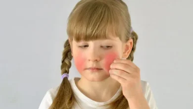صورة ما هي أسباب احمرار الوجه لدى الأطفال؟ وما طرق العلاج؟