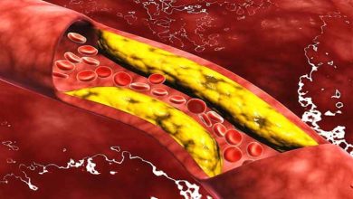 صورة علامة تكشف ارتفاع الكوليسترول بالدم… وهذه طرق علاجه