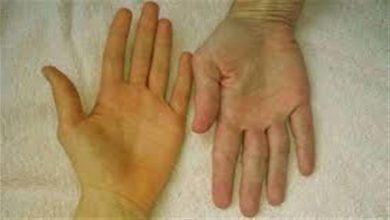 صورة علامة في يديك تكشف الإصابة بأمراض الكبد.. احذرها