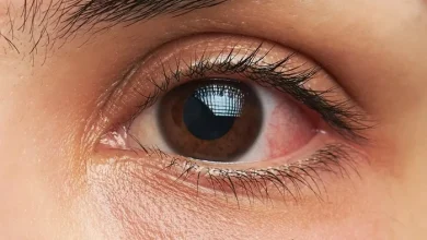 صورة نصائح طبية.. أسباب ألم العين الداخلي وكيفية التعامل معه