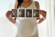 صورة أسباب كلف الحمل .. تعرفوا عليها وعالجوها