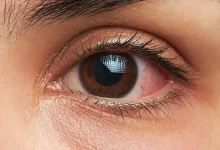 صورة تعرفي إليها.. نصائح فعالة للوقاية من الإصابة بمرض الماء الزرقاء في العين